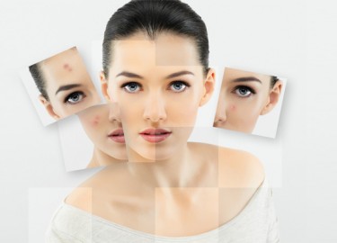 5 cách xua tan MỤN cấp tốc hiệu quả đón tết