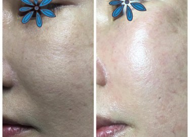 Công nghệ OXY jet Leo de luxe