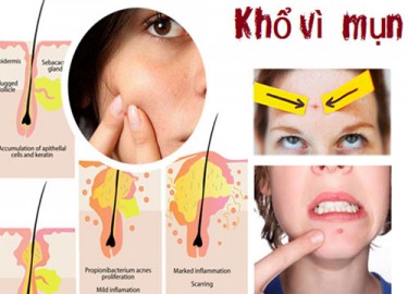 4 CÁCH TRỊ MỤN HIỆU QUẢ MÀ BẠN KHÔNG THỂ BỎ QUA